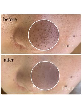 プラセル(Placer)/毛穴の黒ずみも(いちご鼻)