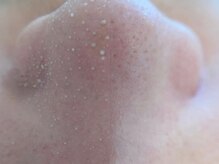 ヴィーヴ 京橋(vive)/【韓国式3D毛穴洗浄】