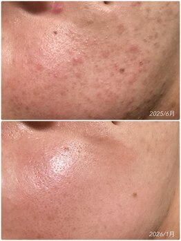 ブライトリー(Brightly)/プラズマシャワーで肌荒れ改善!