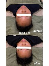 晴々/美容鍼で小顔に！？