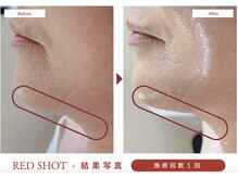 トータルサロン ヴィータ(VITA.)/レッドショット導入でスッキリ♪