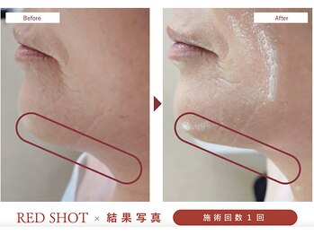 トータルサロン ヴィータ(VITA.)/レッドショット導入でスッキリ♪