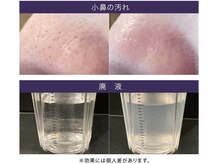 ハイドラスキンで気になる毛穴の汚れをスッキリ！