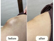 恵比寿ループ鍼灸院(LOOP)/施術写真：鍼灸