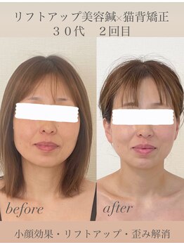 めい鍼灸院/リフトアップ美容鍼×猫背矯正