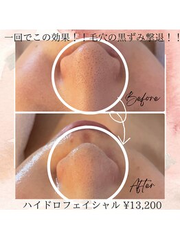 サロン ド ボーテ ラーンジュ 岐阜店(salon de beaut'e L'ange)/本気の肌改善毛穴、ニキビ、小顔