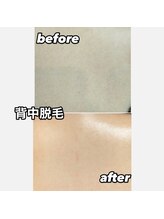 ラヴィ コロレ(La vie colore)/背中脱毛