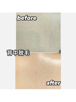 ラヴィ コロレ(La vie colore)/背中脱毛