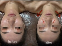 エネ ラッシュアンドブロウ バイ アンドエラ(ENNE Lash&Blow by&ERA)/小顔整体