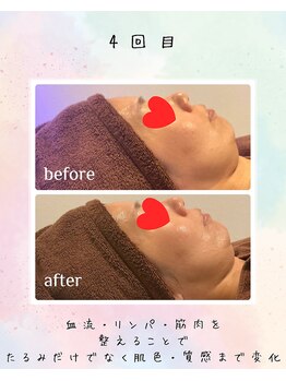 リリアン(lirien)/毛穴/毛穴ケア/毛穴洗浄/駒込