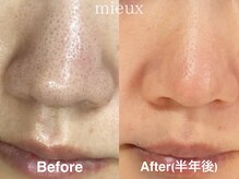 ミュー 岡崎店(mieux)/◇肌質改善◎肌に優しい毛穴ケア