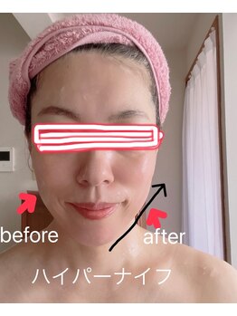 シャインクラフト/ハイパーナイフフェイシャル