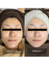 エクラルム(Eclaleum)/BeforeAfter　PHA水光ピーリング