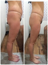 ハワイアンロミロミアンドビューティーサポートサロン ラプア(Lapua)/セルゼロビフォーアフター