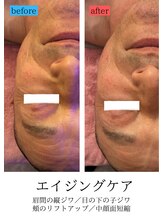 ユフラ(Juhla)/切らない小顔リフト