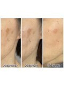 アップル 御幸ヶ原店(Apple.)/肌質改善プログラム