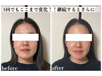 サロンあえる 新大宮店/エラハリ消失小顔！！