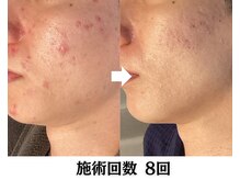 ハーブピーリング&毛穴洗浄専門店 肌REVO 高田馬場店[ニキビ/毛穴/たるみ/美白/シミ]/ハーブピーリング/ニキビケア