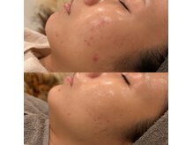 アンジェーム(ANGEAME)の雰囲気（《繰り返すニキビ》土台ケア3ヶ月。内側からの根本再生！）