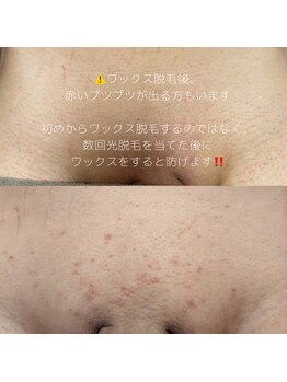カナウ(KANAU)/ワックス後の毛嚢炎に注意！