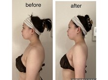 リラココ(リラcoco)/ビフォーアフター（20代お客様）