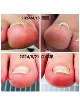 ココネ(cocone)/巻き爪解放ケア