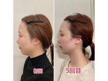 小顔22 ボルティ 赤坂支店(Bolty)/20代：5回【悩み】面長/平面顔