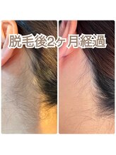 アミクール エステティックサロン(amicoeur)/うなじ脱毛