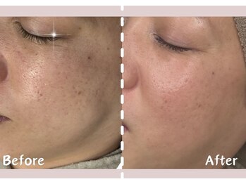 シー センター北(sii)/ララピール×フォト美顔　３回