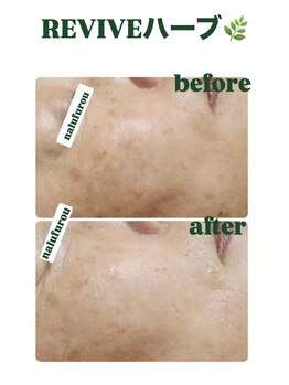 ナルフロウ(nalufurou)/剥離なし国産ハーブピーリング♪