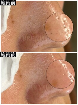 ブレスヘアー アイラッシュ(Breath hair eyelash)/毛穴エクストラクションプロ