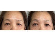 エム ビューティー(M Beauty)/セルラム　ビフォア＆アフター