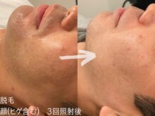 ルーナジェーナ(Luna llena)/脱毛×美肌、同時に叶う。