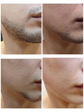 ザ ファーストサロン(The First Salon)/大人気！ヒゲ脱毛