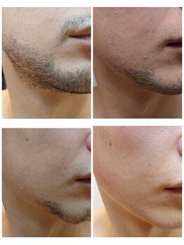 ザ ファーストサロン(The First Salon)/大人気!ヒゲ脱毛