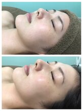 エルサ(Elsa)/陶肌