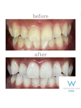 ホワイトニングショップ 町田店/【ビフォーアフター】10回