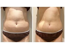 エイシスグロウ(asis glow.)/効果写真