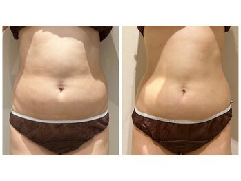 エイシスグロウ(asis glow.)/効果写真