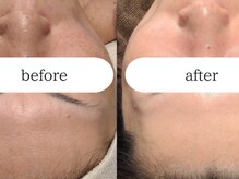 ブラン(BLANC)/【芸能人ピーリング】水光ピール