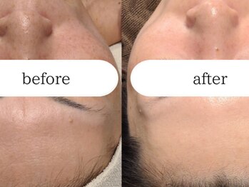 ブラン(BLANC)/【芸能人ピーリング】水光ピール