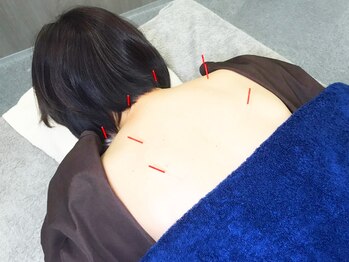 なか鍼灸マッサージ院/鍼(はり)の施術