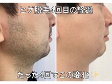 リエル(RIEL)/【ヒゲ脱毛】