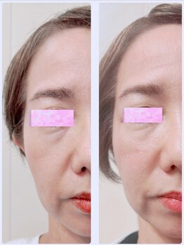 ブロッサム 那覇店/フェイスリリース★効果写真