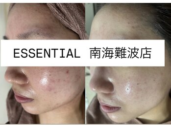 エッセンシャル 南海難波店(ESSENTIAL)/【REVI】ハーブピーリング