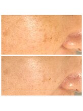 エリン(ERIN)/セラピール