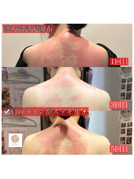 フェアリー 小松店/NEW!漢方温活泥湿布でデトックス