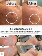 【毛穴|ハーブピーリング】韓国肌管理Belle 稲毛 肌のお悩み 全て改善