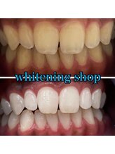 ホワイトニングショップ 本八幡店/Before&After美白ホワイトニング