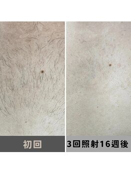 キムラケ 和光別邸(木村家 KIMURAKE)/メンズ脱毛　胸ビフォーアフター